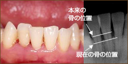 軽度歯周炎