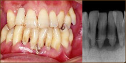 重度歯周炎